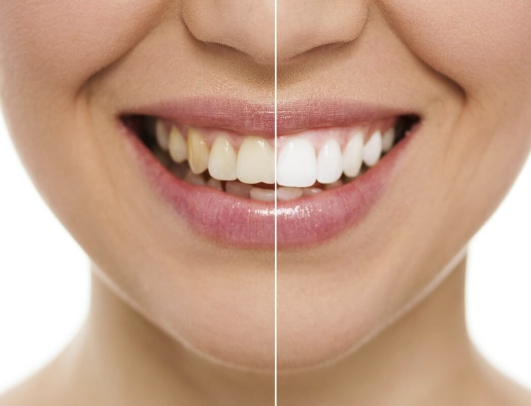 Zoom Whitening: Brighten Your Smile with Confidence