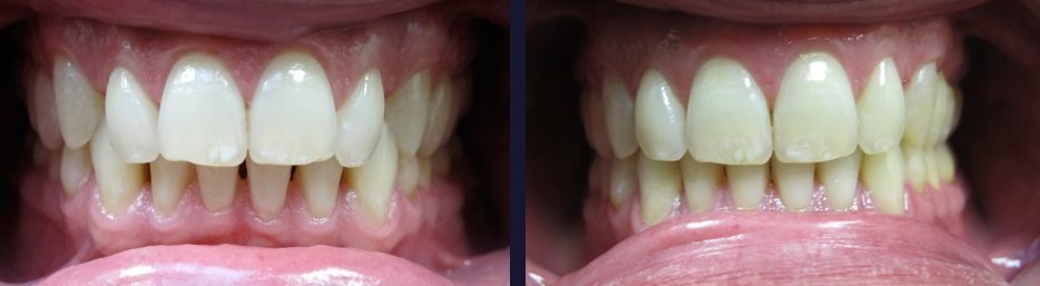 invisalign-result1